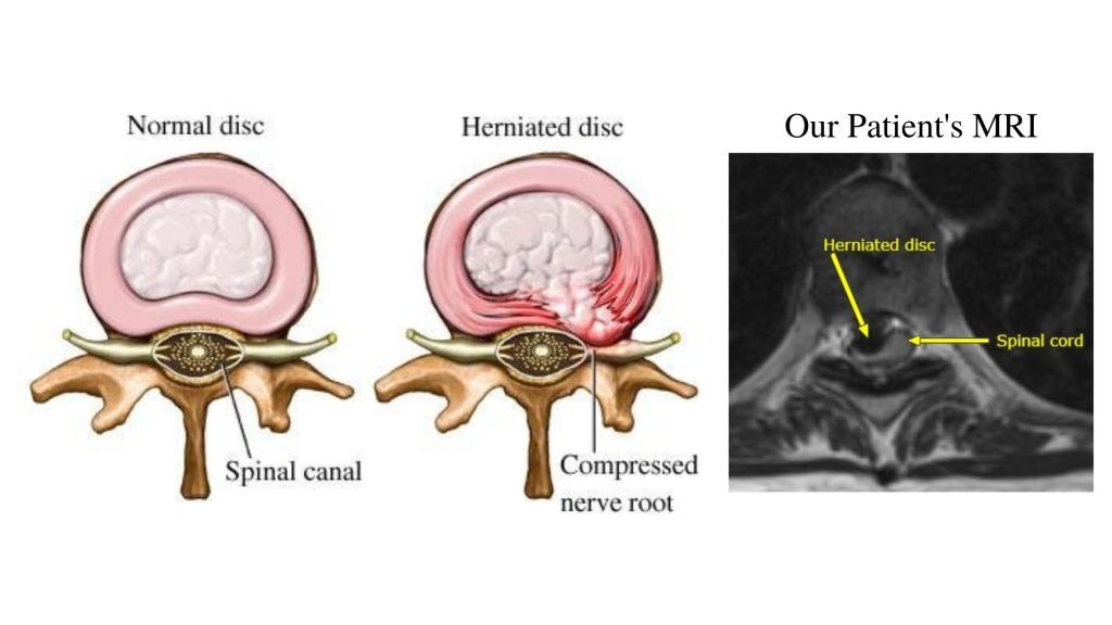 MRI and diagram of herniated vertebral disc