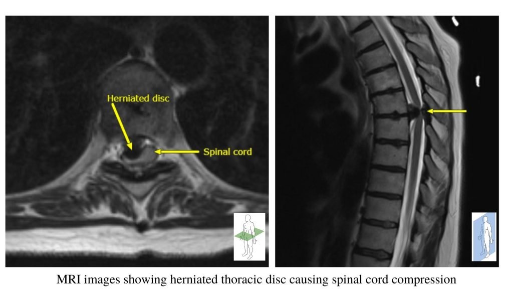 MRI images showing herniated thoracic disc causing spinal cord compression