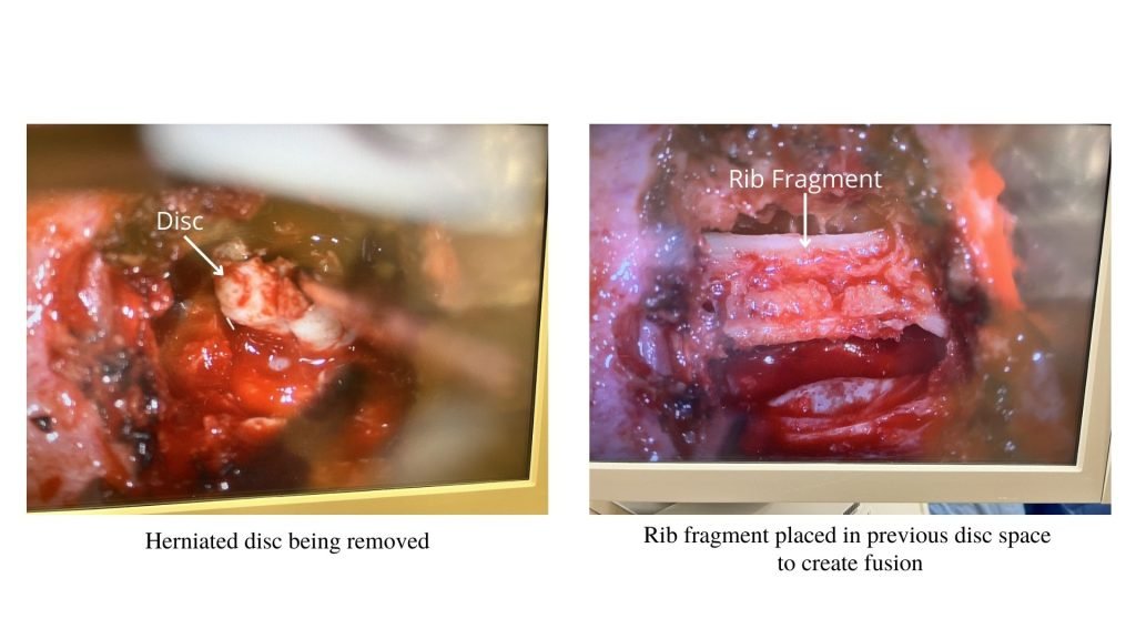 photo of herniated disc removal