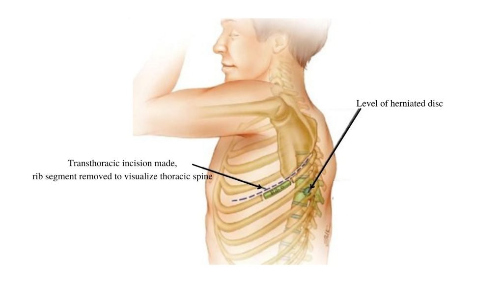 diagram of surgery to repair herniated disc