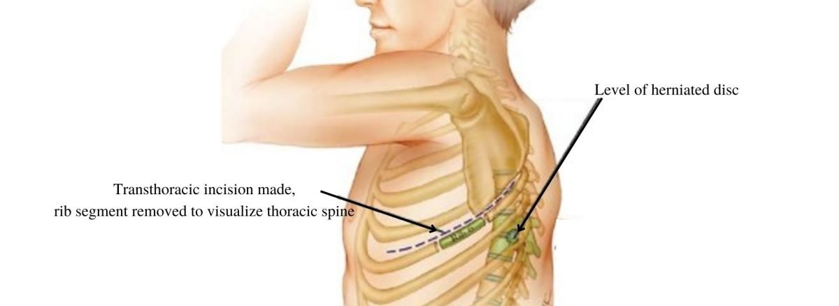 diagram of surgery to repair herniated disc