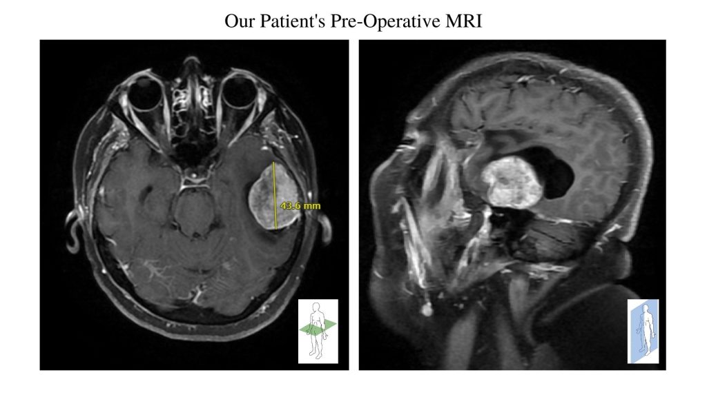preoperative cranial MRI of brain tumor