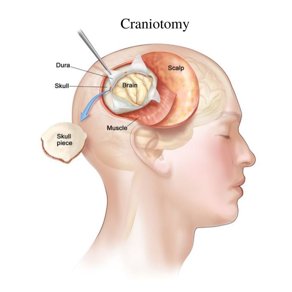 diagram of a craniotomy
