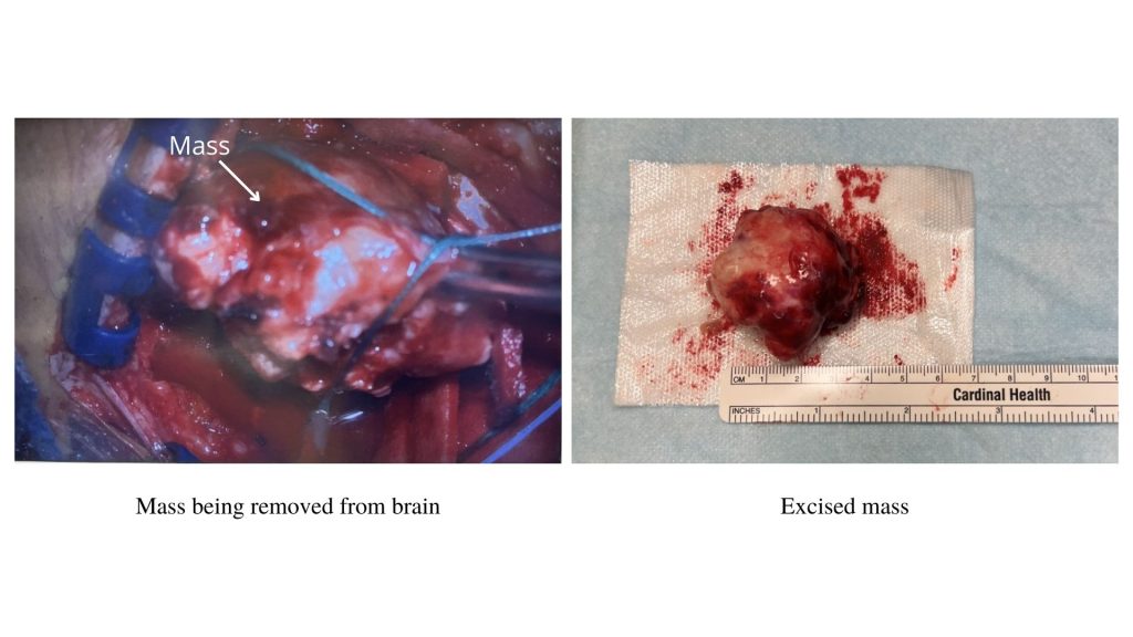 photo of brain tumor removal