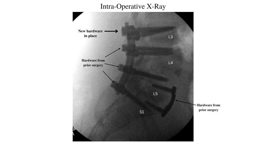 intra-operative X-ray of lumbar spine surgery