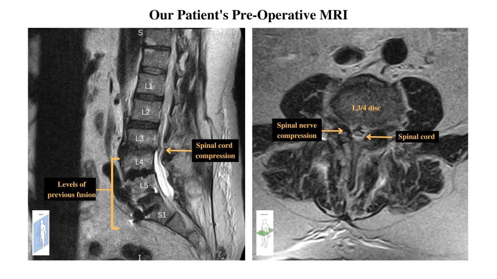 pre-operative MRI of lumbar spinal cord compression