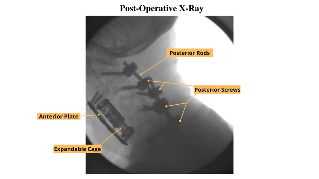post-operative X-ray of cervical spine decompression