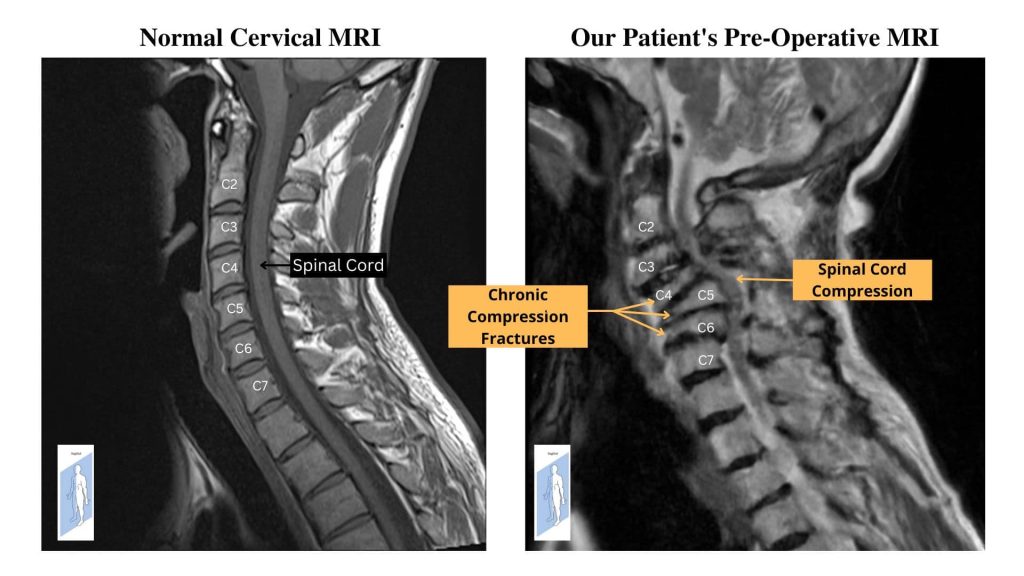 pre-operative MRI of cervical spinal cord compression
