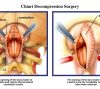 diagram of chiari decompression surgery