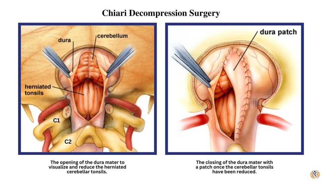 diagram of chiari decompression surgery