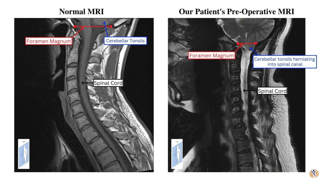pre-operative MRI of chiari malformation