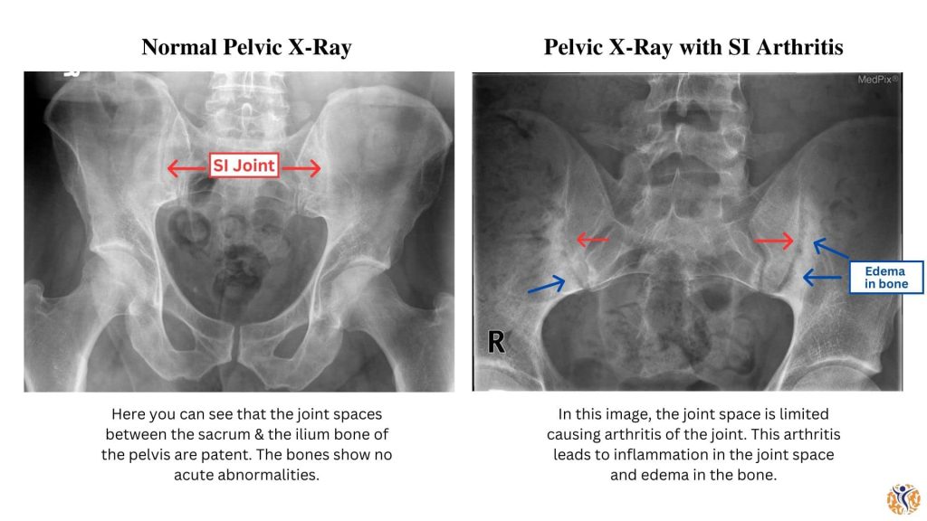 pelvic X-ray of SI arthritis
